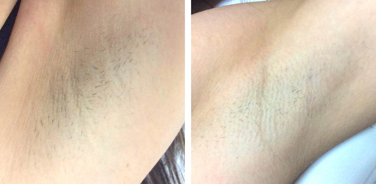 before-after-01